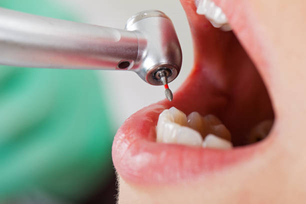 Best Emergency Root Canal Treatment in Tangent, OR